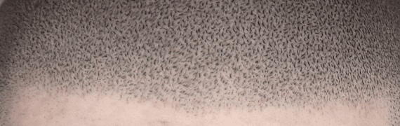 DXBLACK 머신 - 선 시술 결과 이미지